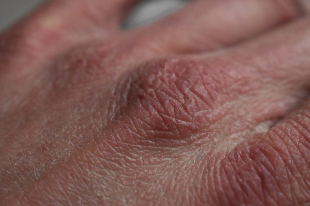 Handrücken mit geröteter Haut