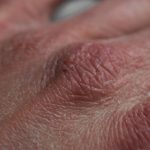 Handrücken mit geröteter Haut